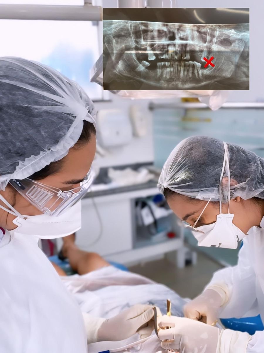 Extração no consultório; no alto, a radiografia panorâmica com o dente marcado em vermelho